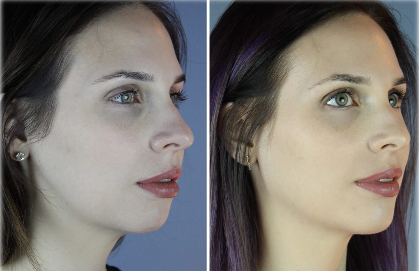 Facelift