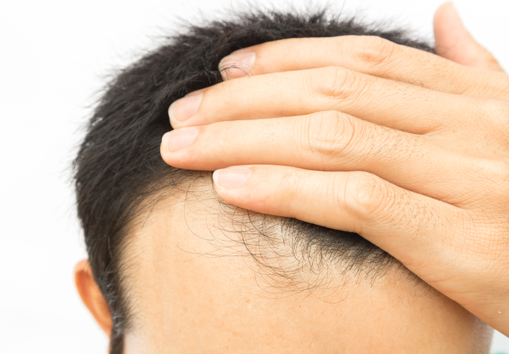 PRP Treatment for Hair Loss Kansas City