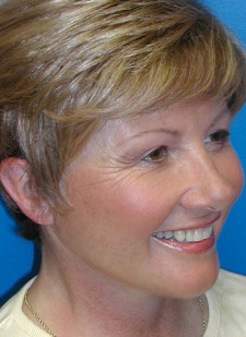 After QuickLift Procedure After QuickLift procedure photo