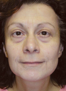 Patient-19-Before Patient-19-Before