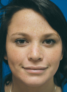 Rhinoplasty30-After