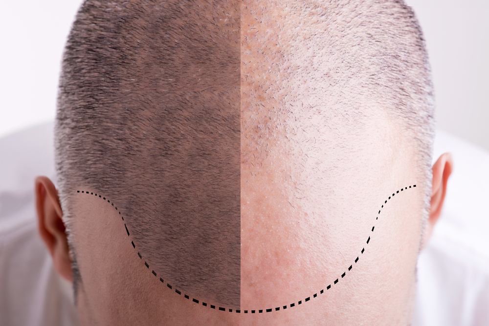 Hair Loss PRP Treatments