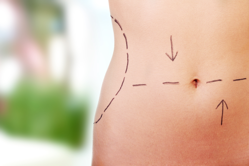 Traditional vs Laser Liposuction