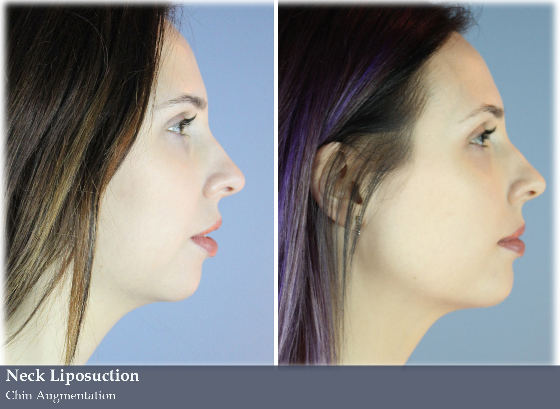 Neck Lift Vargas Face and Skin Center