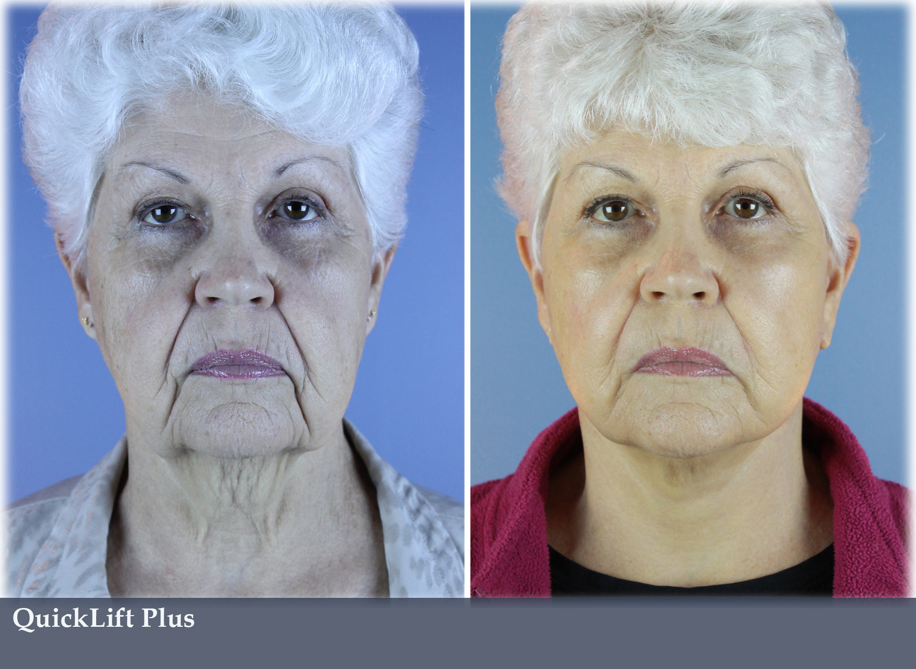 Quick Lift Vargas Face And Skin Center