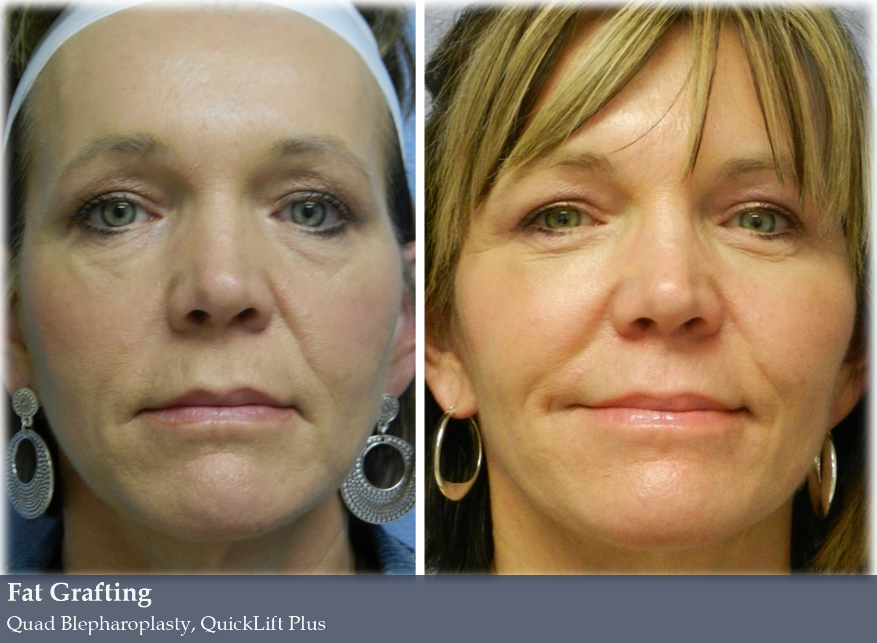 Fat Grafting Vargas Face And Skin Center