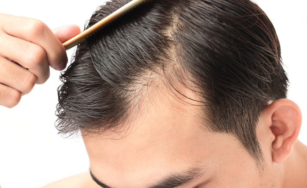 PRP Injection for Hair Loss