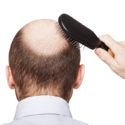 Hair Transplants: What You Need To Know