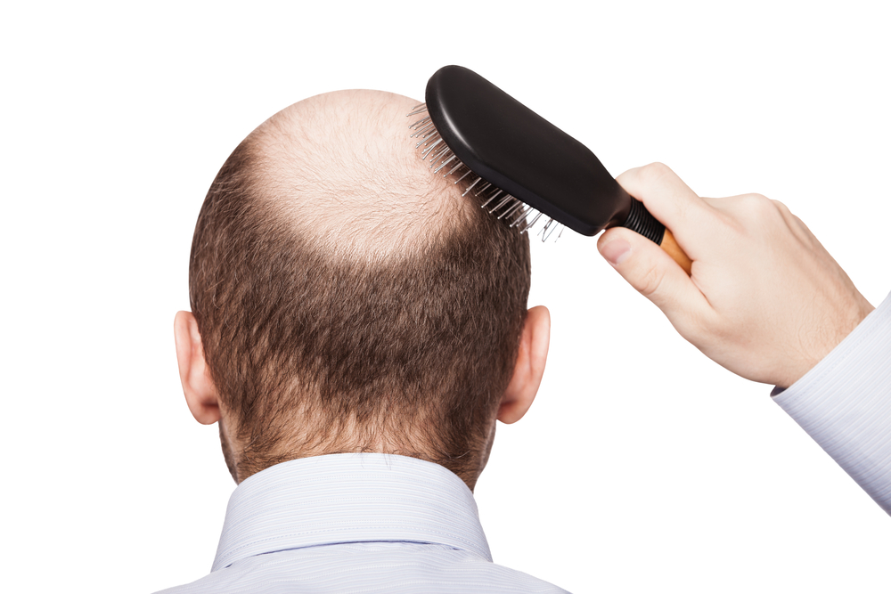 hair-transplants-what-you-need-to-know