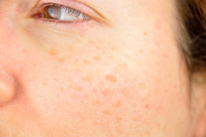 brown-spots-on-face