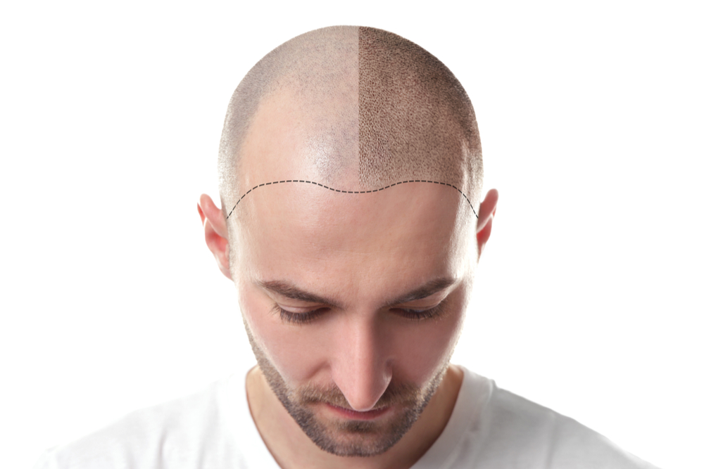 Why Men are Balding in Their 20s  Vargas Face and Skin Center