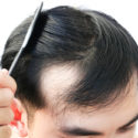 Why Men Are Balding In Their 20s