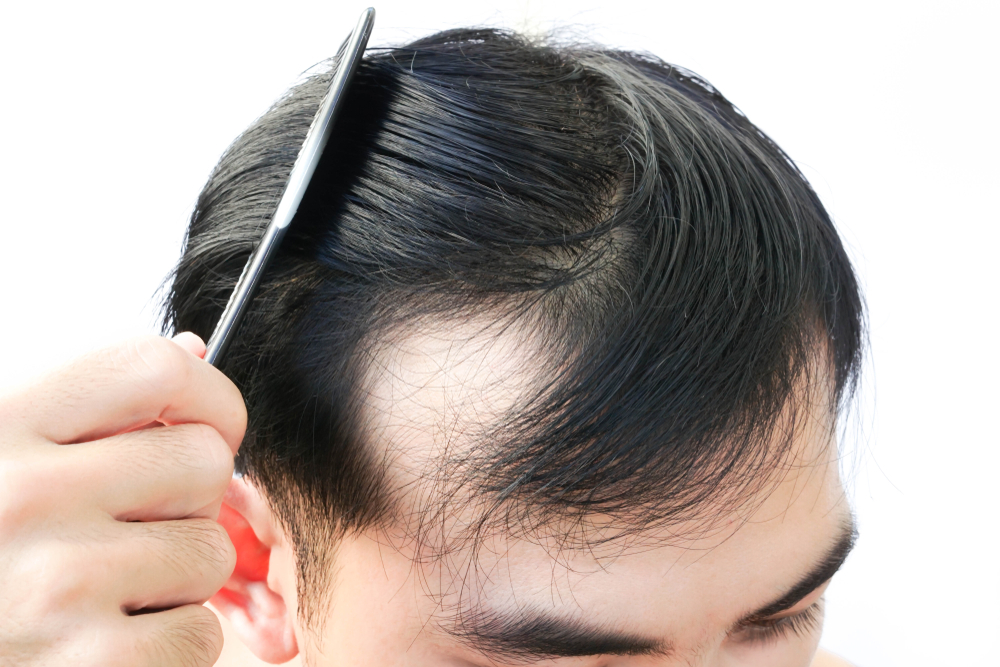 Why Men are Balding in Their 20s  Vargas Face and Skin Center