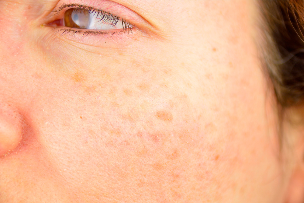 age-spots-on-skin