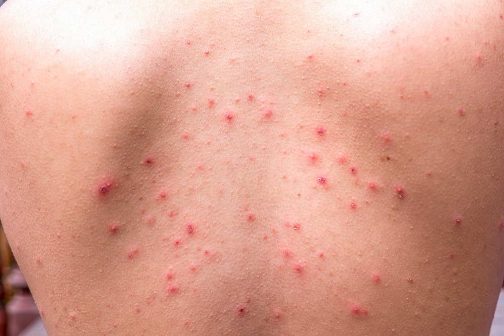 how-to-get-rid-of-back-acne