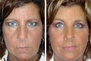 browlift-before-after-vargas-face-and-skin-center