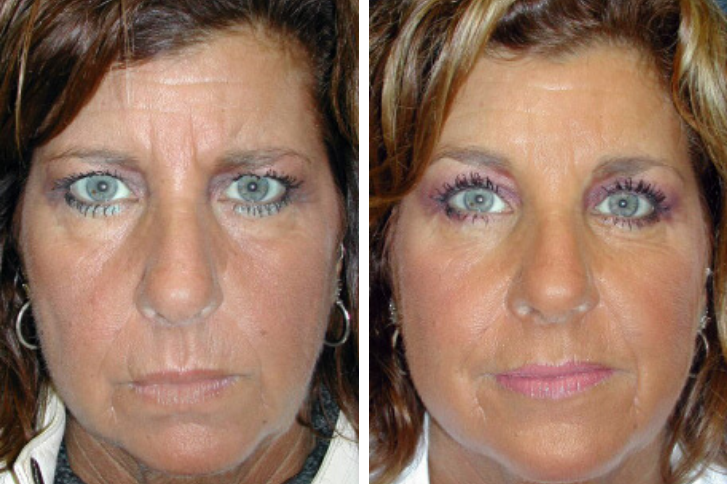Botox Brow Lift Vs Surgical Lift Vargas Face And Skin Center