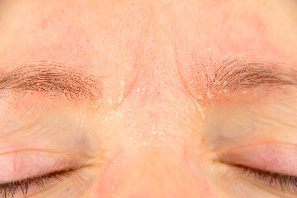 dry-skin-around-eyes