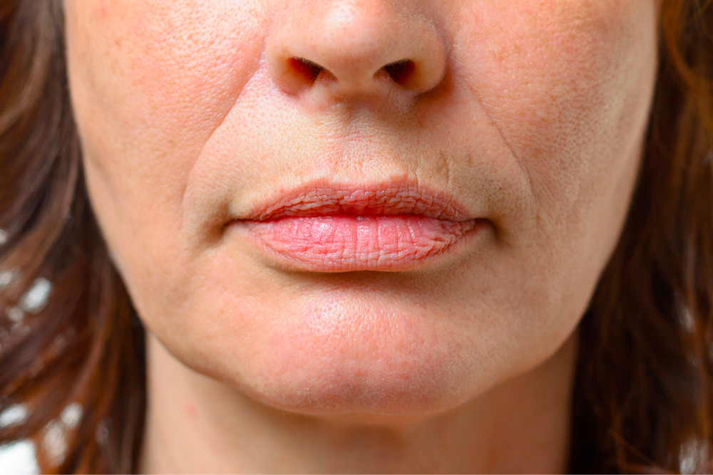 The 6 Best Upper Lip Wrinkle Treatments