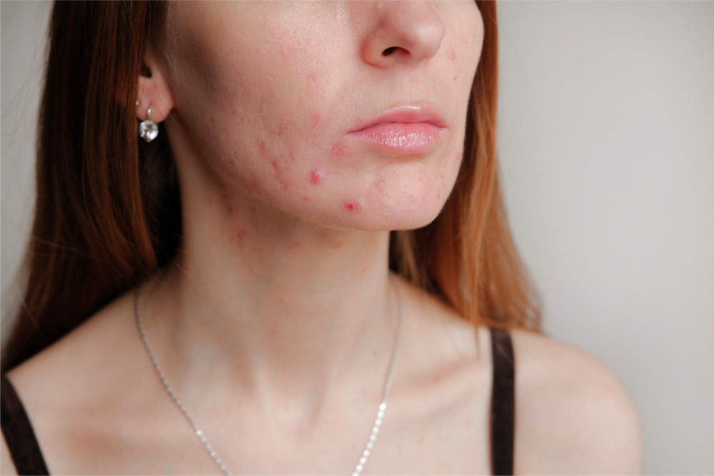 acne-on-face