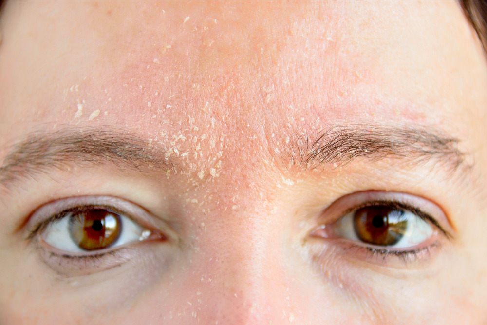 Dry Spots on Skin: How it Happens - Vargas Face and Skin Center