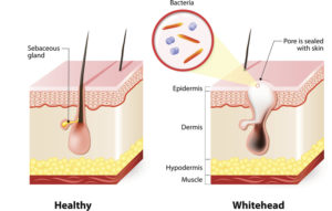 healthy-skin-vs-acne