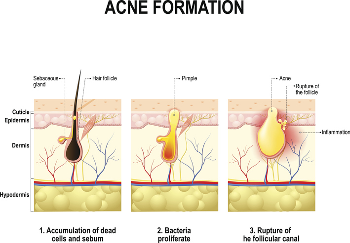 how-acne-forms