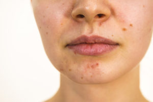 jawline-acne