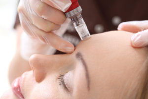 skin-pen-microneedling