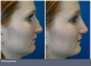 rhinoplasty-surgical