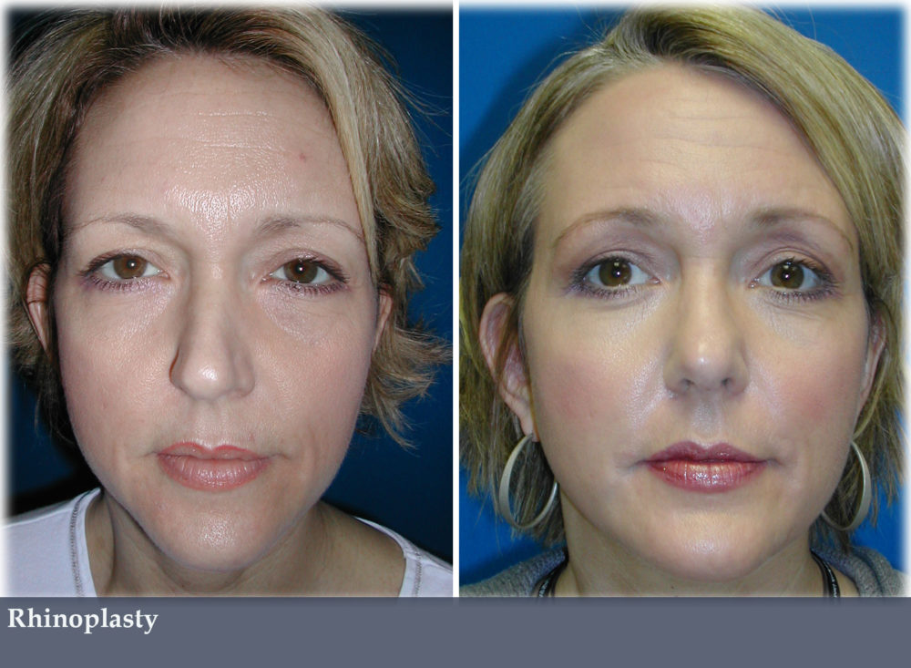 Dr. Trussler Rhinoplasty Surgery