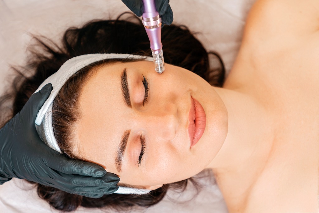 microneedling