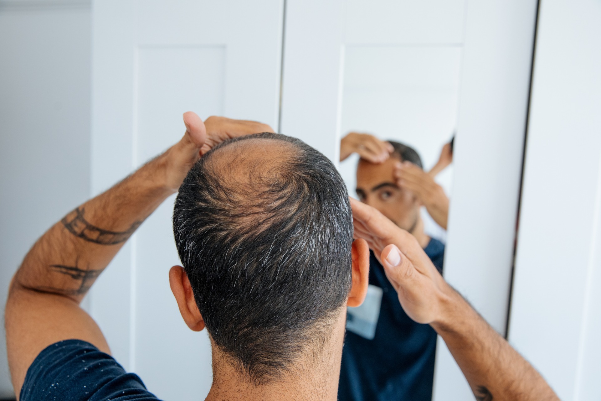 A man suffering from hair loss