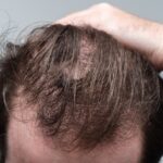 This Is A Photo Of A Main Suffering From Hair Loss.