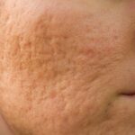 Acne Scars