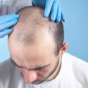 The Evolution Of Hair Transplant Techniques: From FUT To FUE