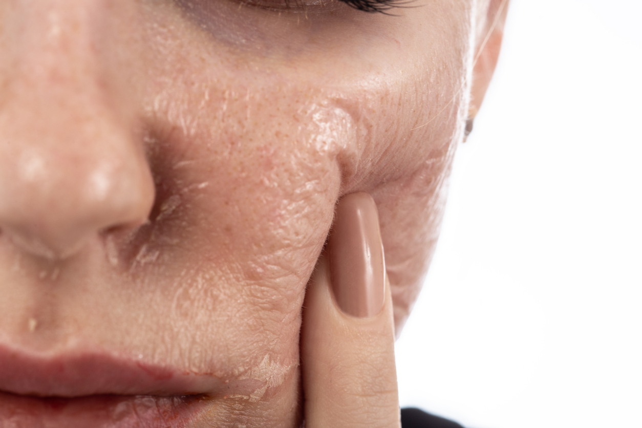 chemical-peel-peeling