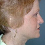 Neck Lift Before & After Patient #6749