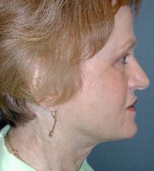 Neck Lift Before & After Patient #6749