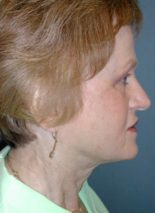 Neck Lift Before & After Patient #6749