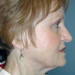 Neck Lift Before & After Patient #6749