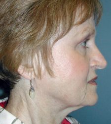 Neck Lift Before & After Patient #6749