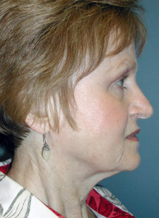Neck Lift Before & After Patient #6749