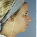 Neck Liposuction Before & After Patient #5301