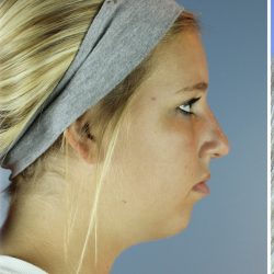 Neck Liposuction Before & After Patient #5301
