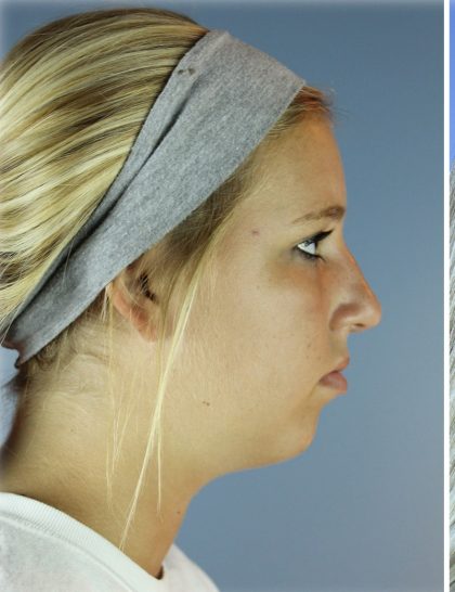Neck Liposuction Before & After Patient #5301