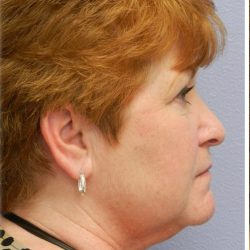 QuickLift Before & After Patient #5375