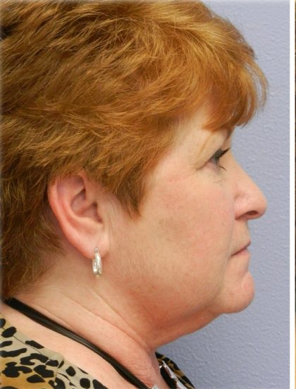QuickLift Before & After Patient #5375