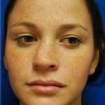 Rhinoplasty Before & After Patient #5810