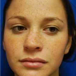 Rhinoplasty Before & After Patient #5810